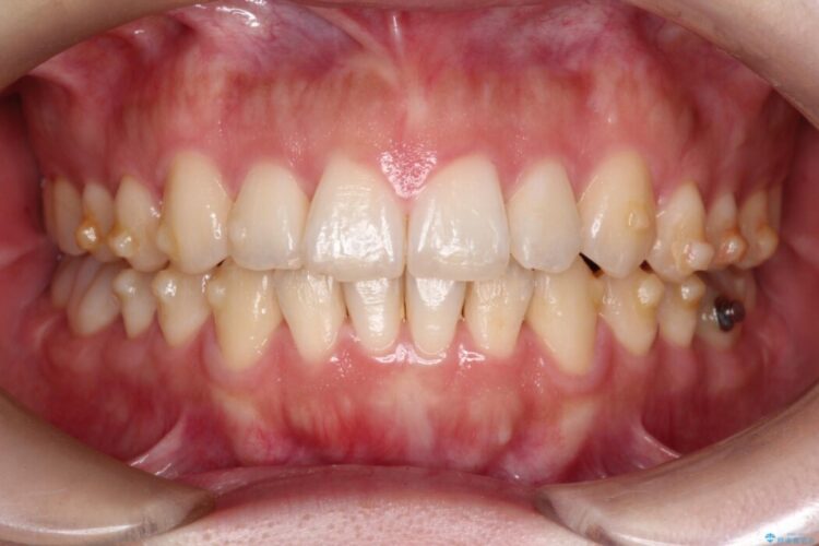 前歯の凸凹をインビザラインできれいなアーチに 治療途中画像