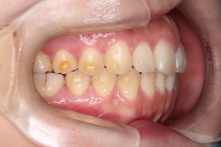 前歯の凸凹をインビザラインできれいなアーチに 治療途中画像