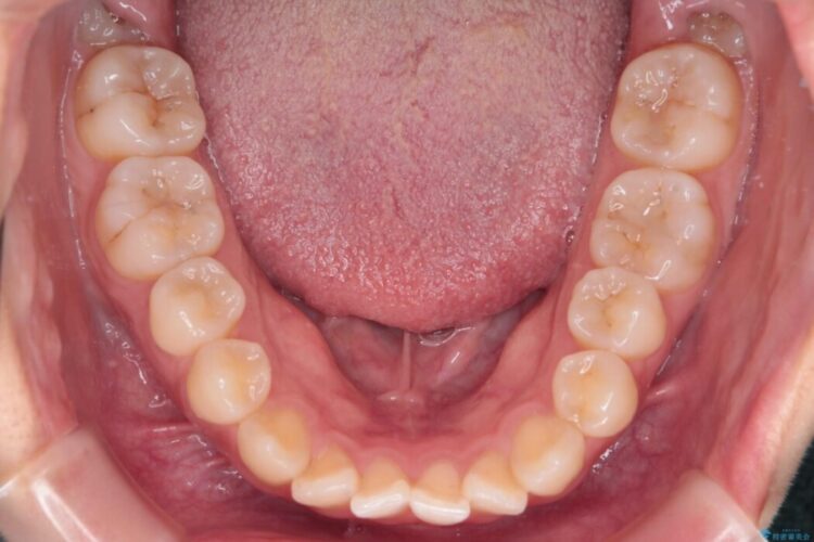 前歯の凸凹をインビザラインできれいなアーチに 治療前画像