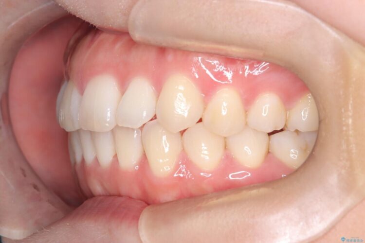 前歯の凸凹をインビザラインできれいなアーチに 治療後画像