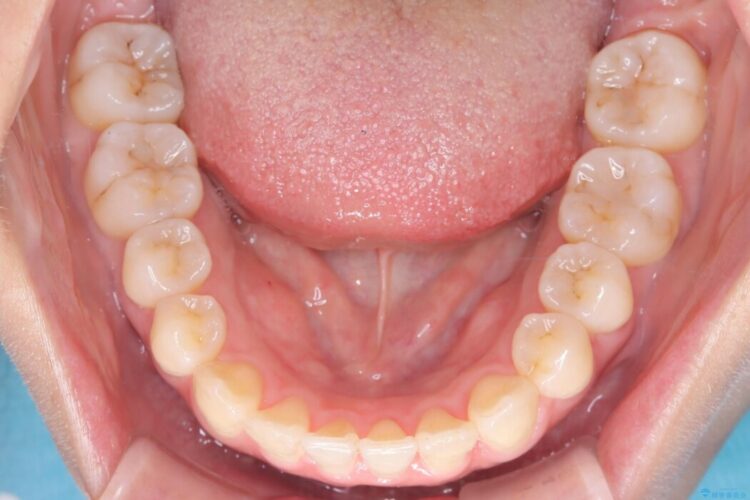 前歯の凸凹をインビザラインできれいなアーチに 治療後画像
