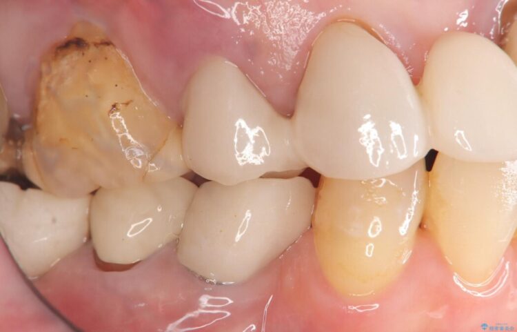 歯根破折による抜歯即時インプラント（1DAYインプラント） ビフォー