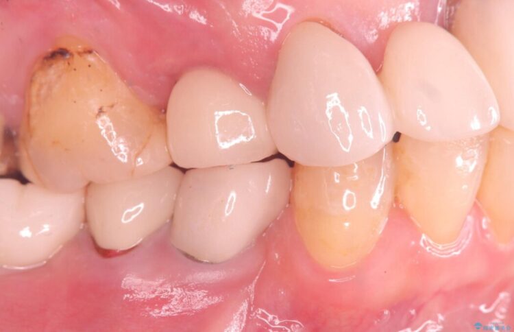 歯根破折による抜歯即時インプラント（1DAYインプラント） アフター