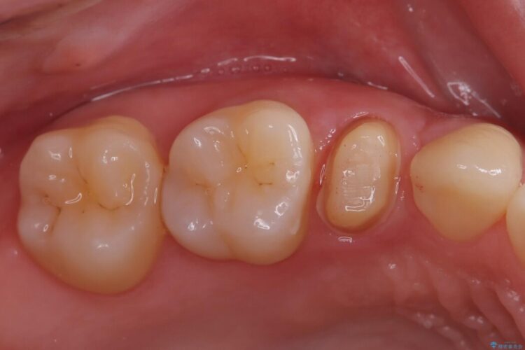 【セラミッククラウン】定期健診で発覚した破折線と虫歯の補綴 治療途中画像
