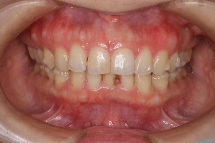 左右で歯の本数が違う場合のマウスピース矯正治療 治療途中画像