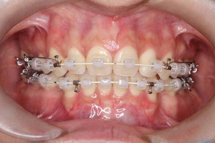 Eライン（エステティックライン）を整える歯列矯正 治療途中画像