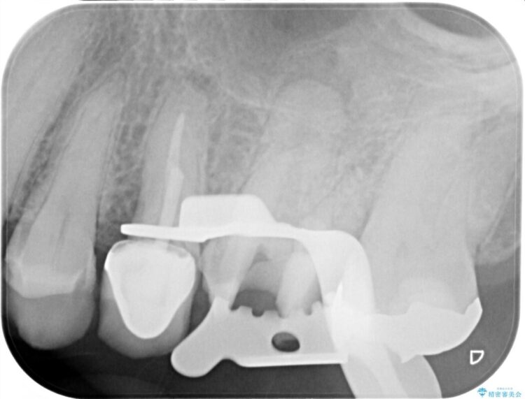他院で根管治療をした際に残った破折ファイルを取り除きたい 治療途中画像