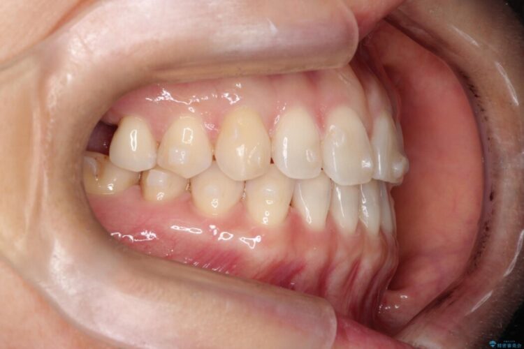 【再矯正】歯列矯正の後戻りをインビザラインで治療する 治療途中画像
