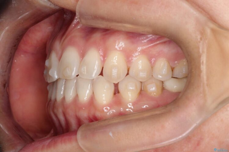 【再矯正】歯列矯正の後戻りをインビザラインで治療する 治療途中画像