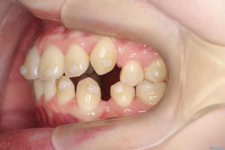 【抜歯矯正】八重歯をインビザラインで整える 治療途中画像
