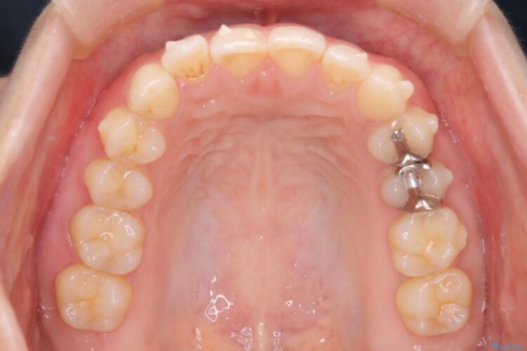 左右で歯の本数が違う場合のマウスピース矯正治療 治療途中画像