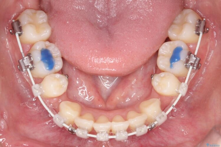 Eライン（エステティックライン）を整える歯列矯正 治療途中画像