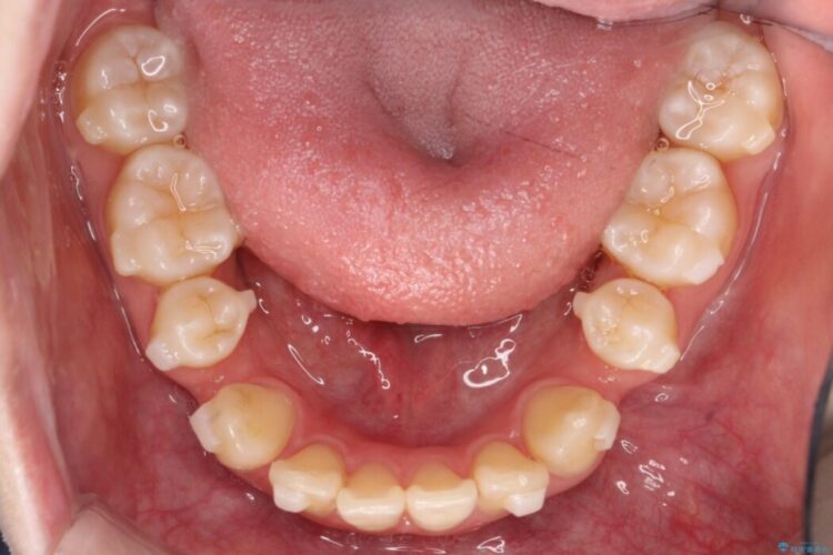 【抜歯矯正】八重歯をインビザラインで整える 治療途中画像