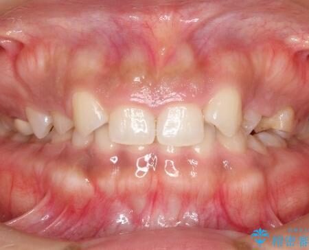 【総合歯科治療】後続永久歯の欠損 治療前