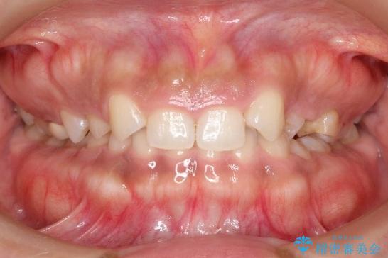 【総合歯科治療】後続永久歯の欠損 治療前