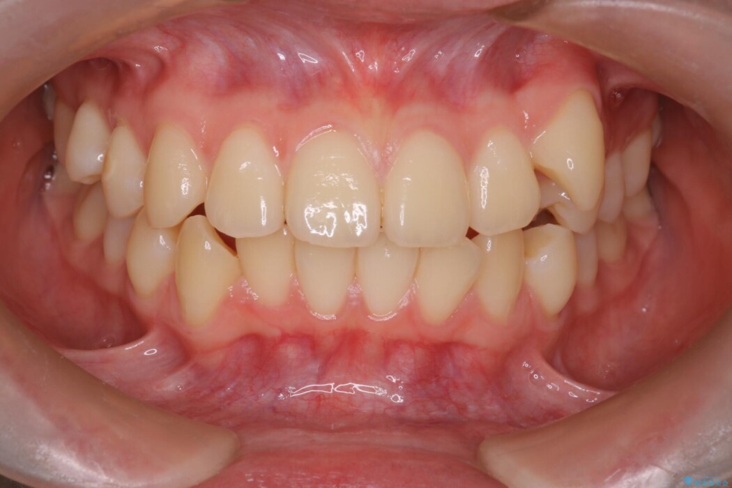 【抜歯矯正】八重歯をインビザラインで整える 治療前
