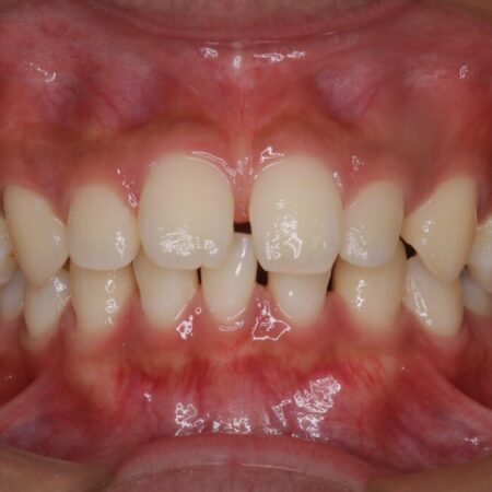 空隙歯列（すきっ歯）の矯正治療 治療前