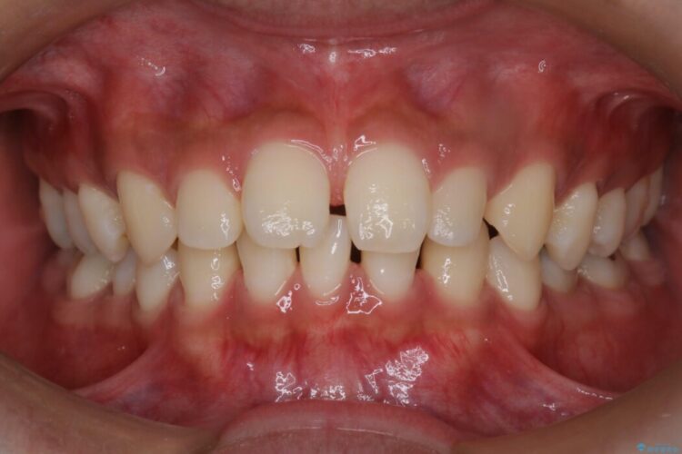 空隙歯列（すきっ歯）の矯正治療 ビフォー