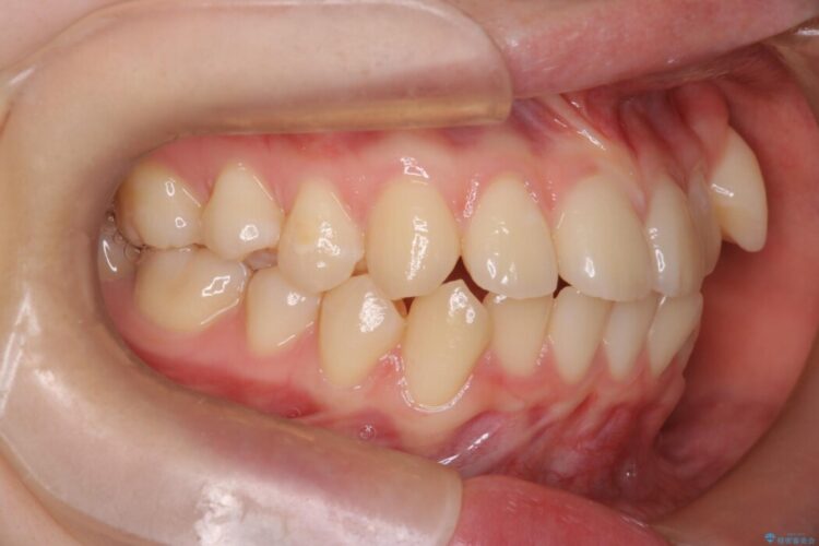 【抜歯矯正】八重歯をインビザラインで整える 治療前画像
