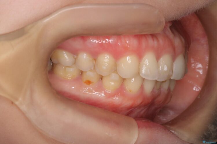 左右で歯の本数が違う場合のマウスピース矯正治療 治療前画像