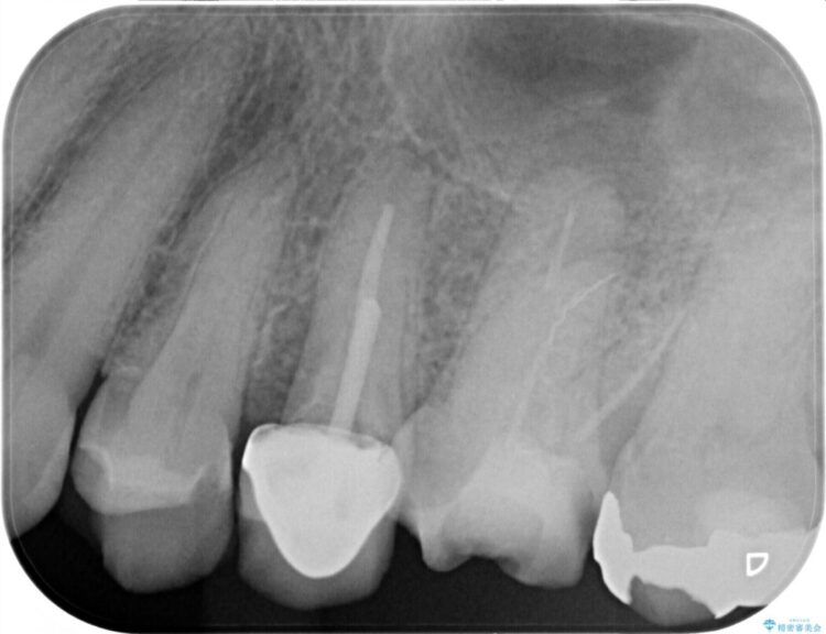 他院で根管治療をした際に残った破折ファイルを取り除きたい 治療前画像
