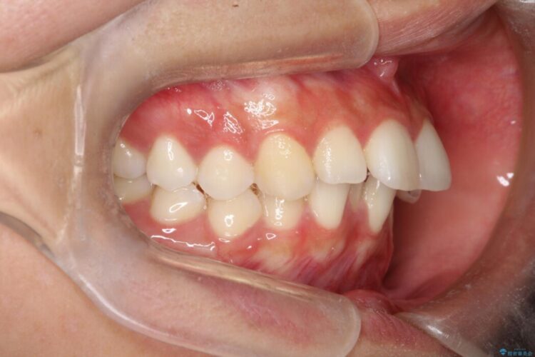 Eライン（エステティックライン）を整える歯列矯正 治療前画像