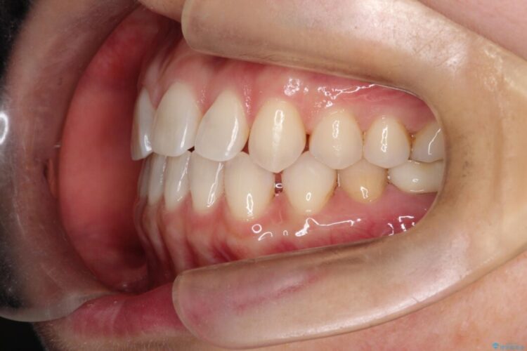 【再矯正】歯列矯正の後戻りをインビザラインで治療する 治療前画像