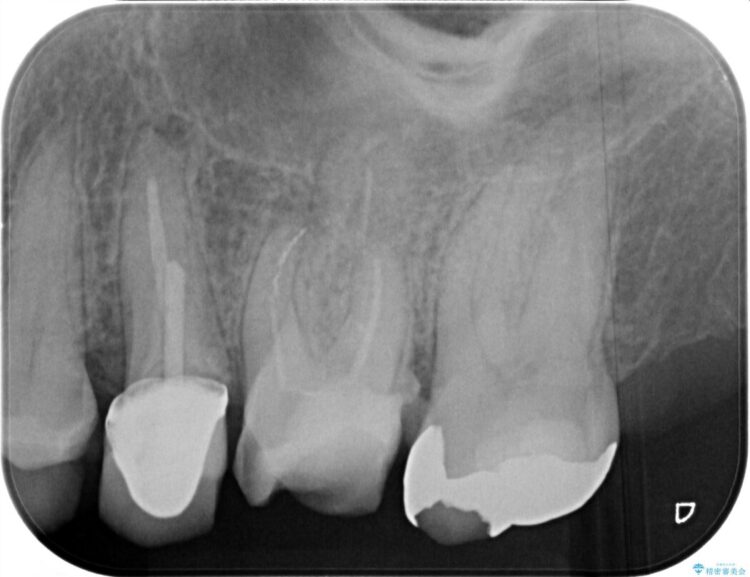 他院で根管治療をした際に残った破折ファイルを取り除きたい 治療前画像