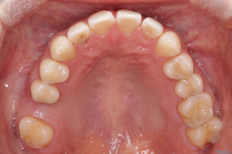 【再矯正】歯列矯正の後戻りをインビザラインで治療する 治療前画像