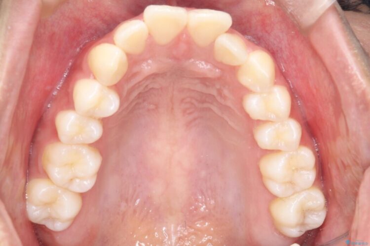Eライン（エステティックライン）を整える歯列矯正 治療前画像