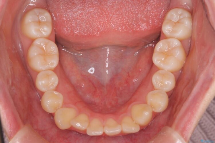 【抜歯矯正】八重歯をインビザラインで整える 治療前画像