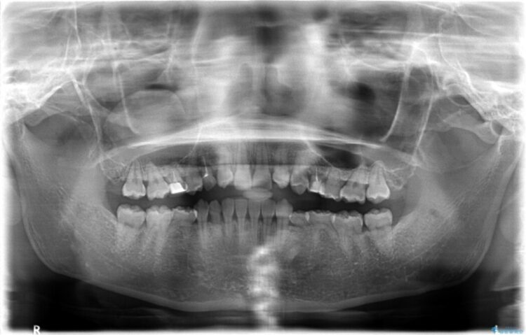 【総合歯科治療】後続永久歯の欠損 治療前画像