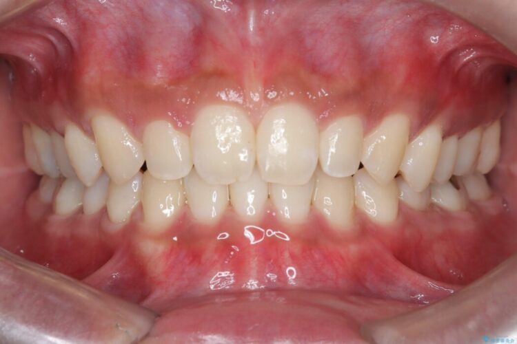 空隙歯列（すきっ歯）の矯正治療 アフター