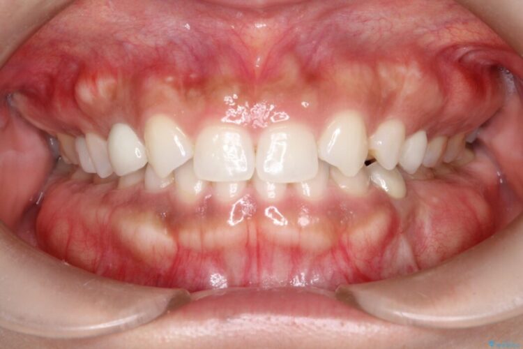 【総合歯科治療】後続永久歯の欠損 アフター