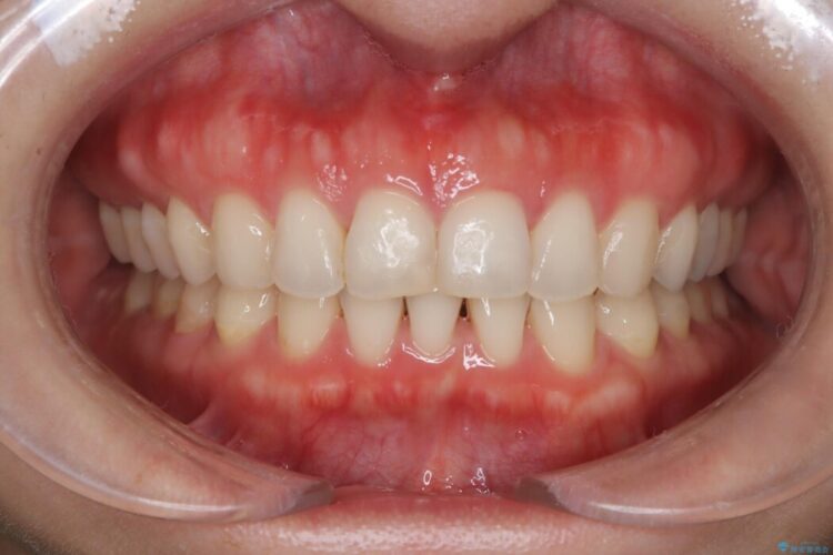 左右で歯の本数が違う場合のマウスピース矯正治療 アフター
