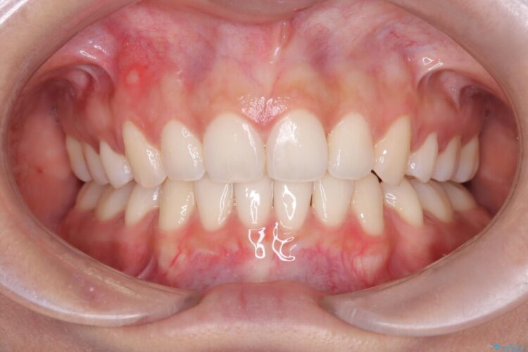 Eライン（エステティックライン）を整える歯列矯正 治療後画像