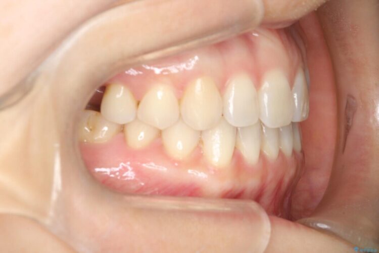 【再矯正】歯列矯正の後戻りをインビザラインで治療する 治療後画像