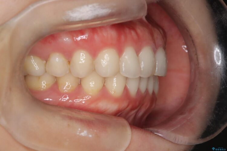 左右で歯の本数が違う場合のマウスピース矯正治療 治療後画像