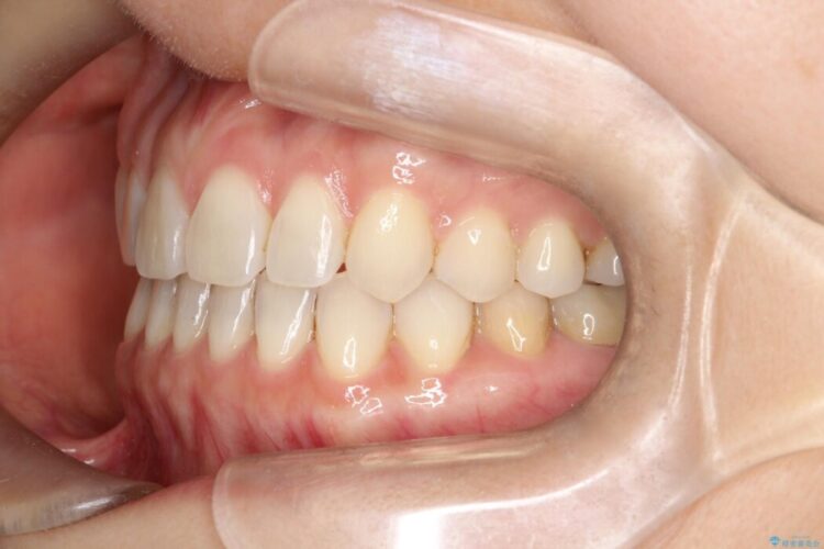 【再矯正】歯列矯正の後戻りをインビザラインで治療する 治療後画像