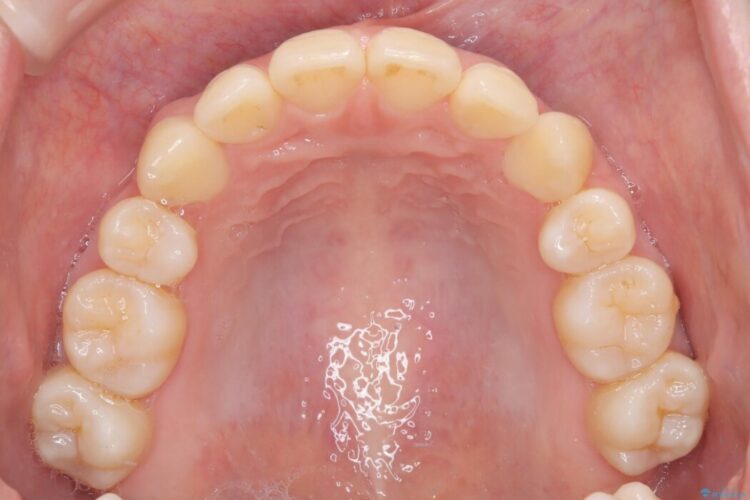 【抜歯矯正】八重歯をインビザラインで整える 治療後画像