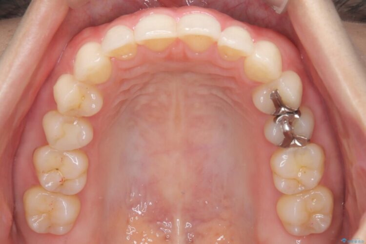 左右で歯の本数が違う場合のマウスピース矯正治療 治療後画像