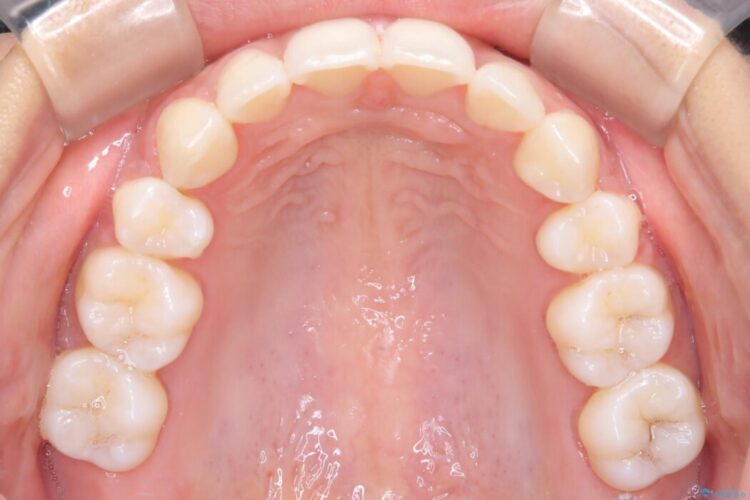 Eライン（エステティックライン）を整える歯列矯正 治療後画像