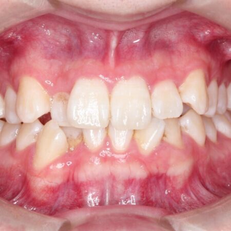 【非抜歯】凸凹な前歯をインビザラインで歯列矯正 治療前