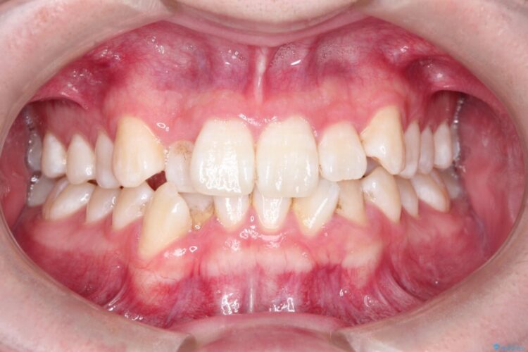 【非抜歯】凸凹な前歯をインビザラインで歯列矯正 ビフォー