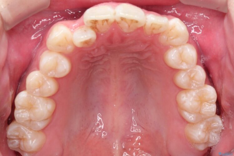 【非抜歯】凸凹な前歯をインビザラインで歯列矯正 治療前画像