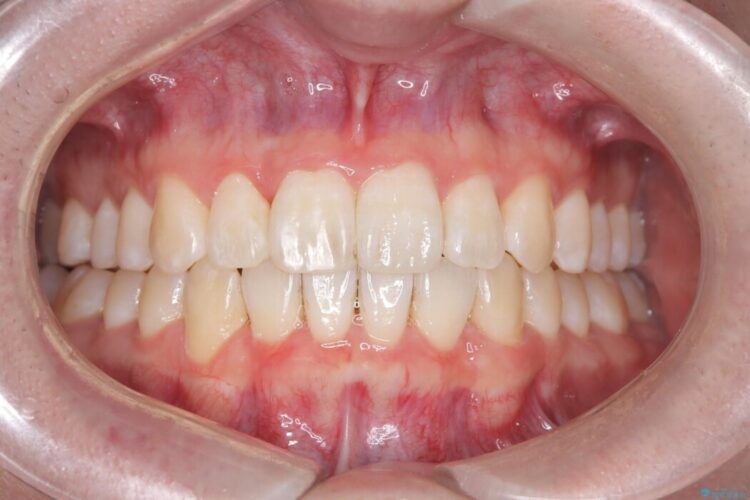 【非抜歯】凸凹な前歯をインビザラインで歯列矯正 アフター