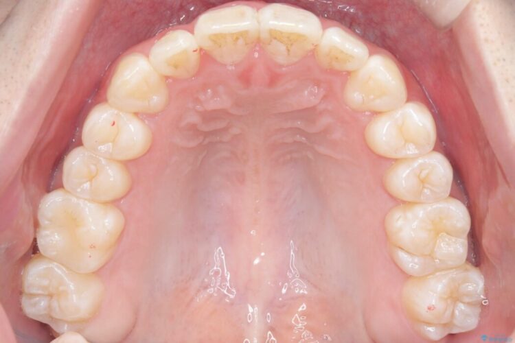 【非抜歯】凸凹な前歯をインビザラインで歯列矯正 治療後画像