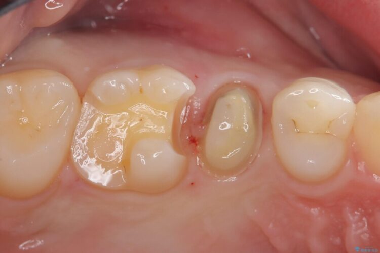 歯髄近くまで広がった深い虫歯を部分的断髄法で治療する 治療途中画像