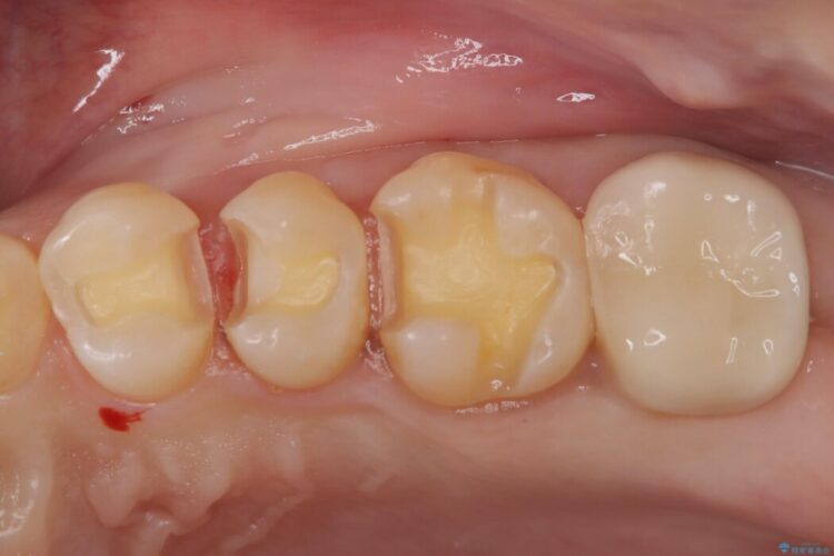 定期検診にて虫歯を発見しセラミックで治療 治療途中画像