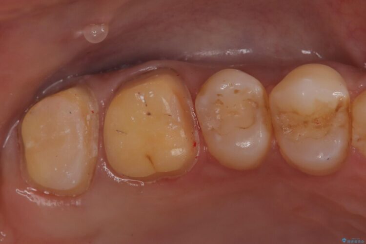 ズキズキと痛む奥の虫歯を根管治療とオールセラミッククラウンで修復 治療途中画像